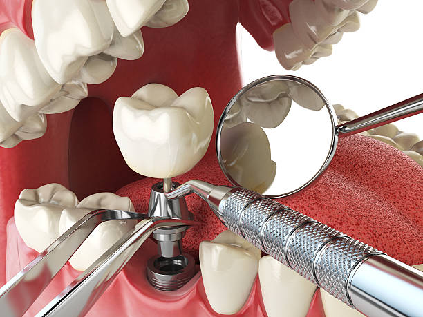 Best Emergency Dentist for Knocked-Out Tooth in Doraville, GA